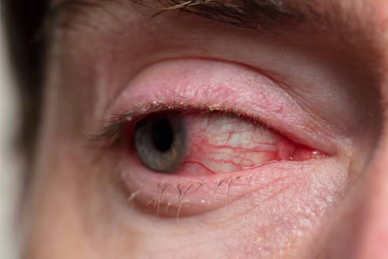 Невелике запалення очей