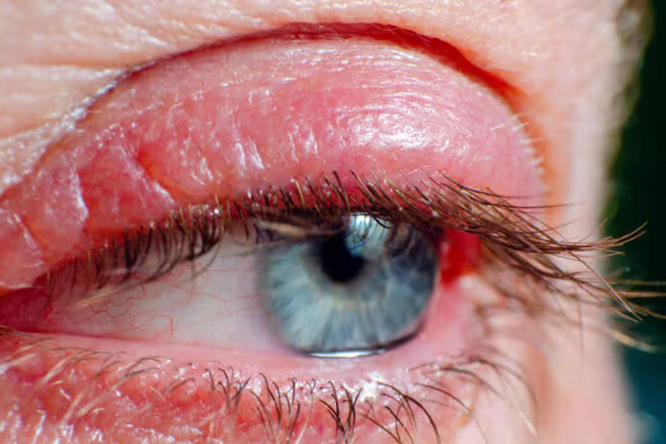 Інфіковане око